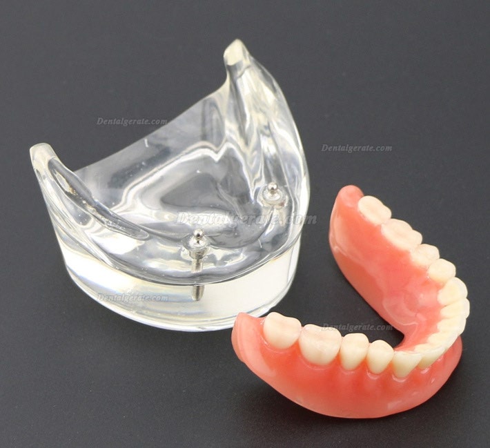 Modell f&uuml;r zahn&auml;rztliche Oberz&auml;hne Overdenture Superior 4 Implantate Demo Modell 6001 02